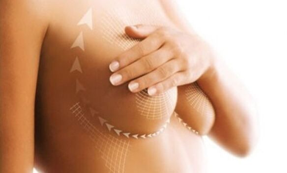lift stitches for breast augmentation