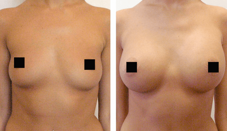 breast before and after augmentation with hyaluronic acid