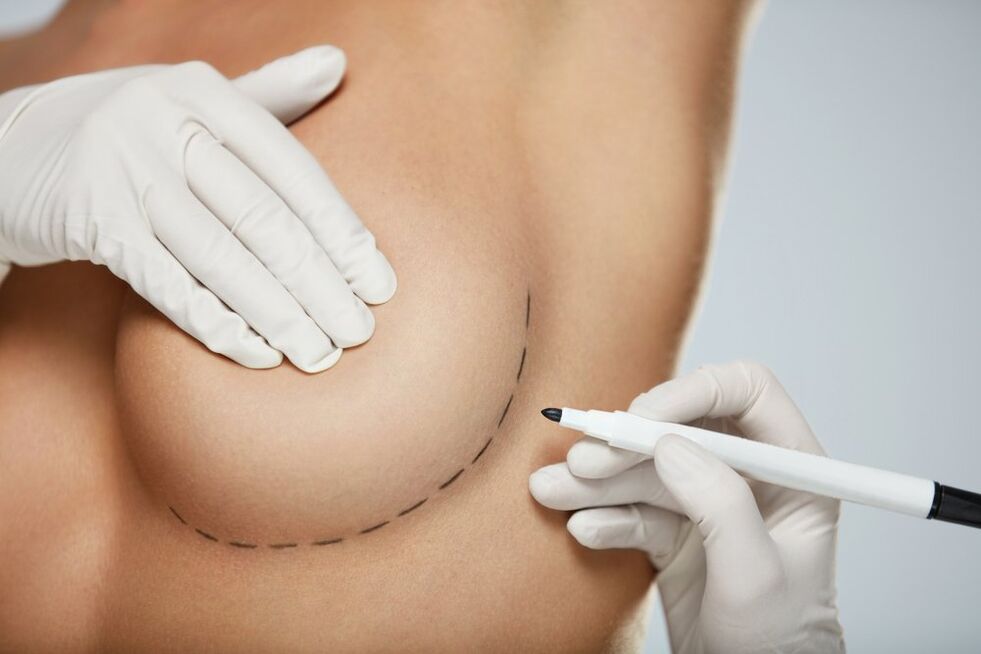 breast periareolar mammoplasty
