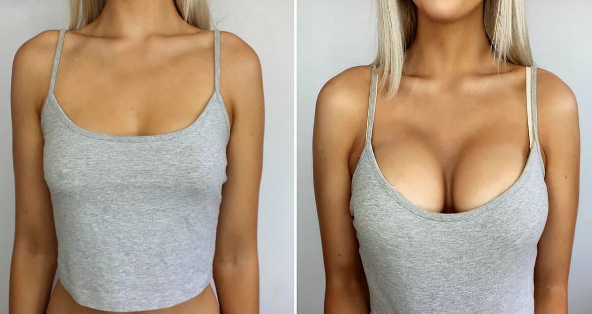 Breast enlargement 3 sizes