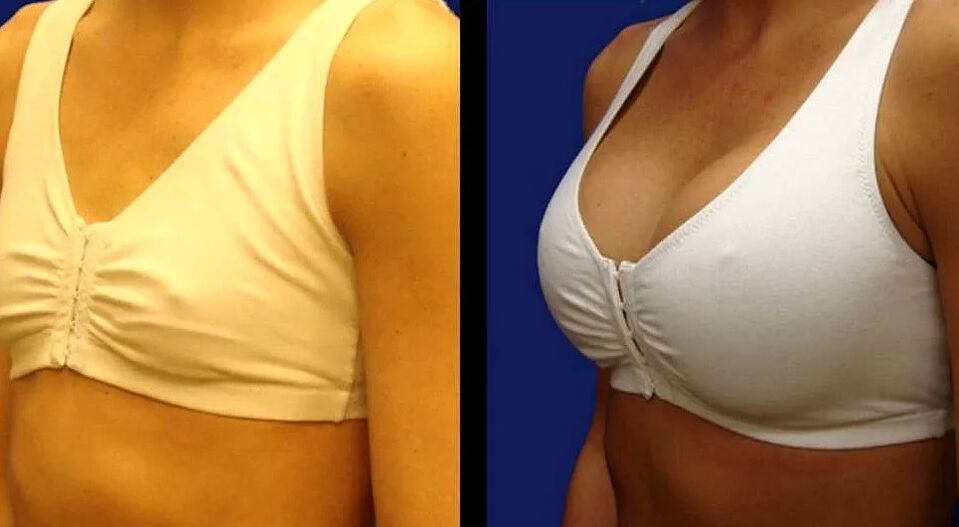 Pictures of breasts before and after surgery