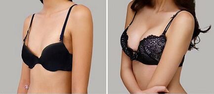 Picture before and after breast enlargement