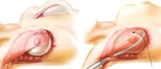 How breast enlargement operations are performed
