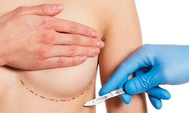 Submammari access to breast enlargement with implant