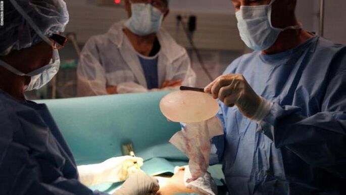Features -Mammoplasty Features
