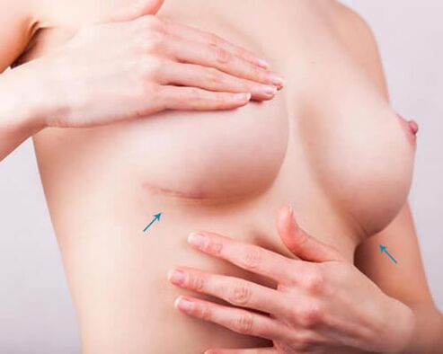 Breast enlargement with implant