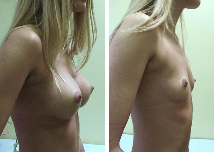 Results of breast augmentation with implants