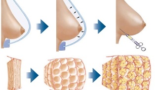 how breast augmentation procedures are performed with fat