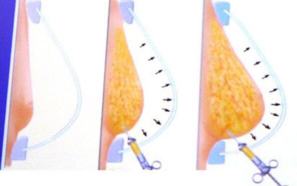 breast augmentation with fat