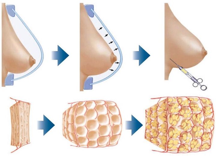 breast augmentation surgery