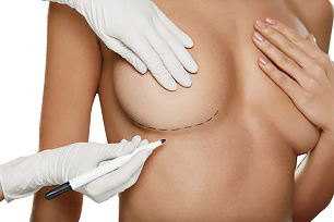 Mark with markers before breast augmentation surgery