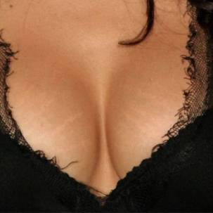 instructions for breast augmentation
